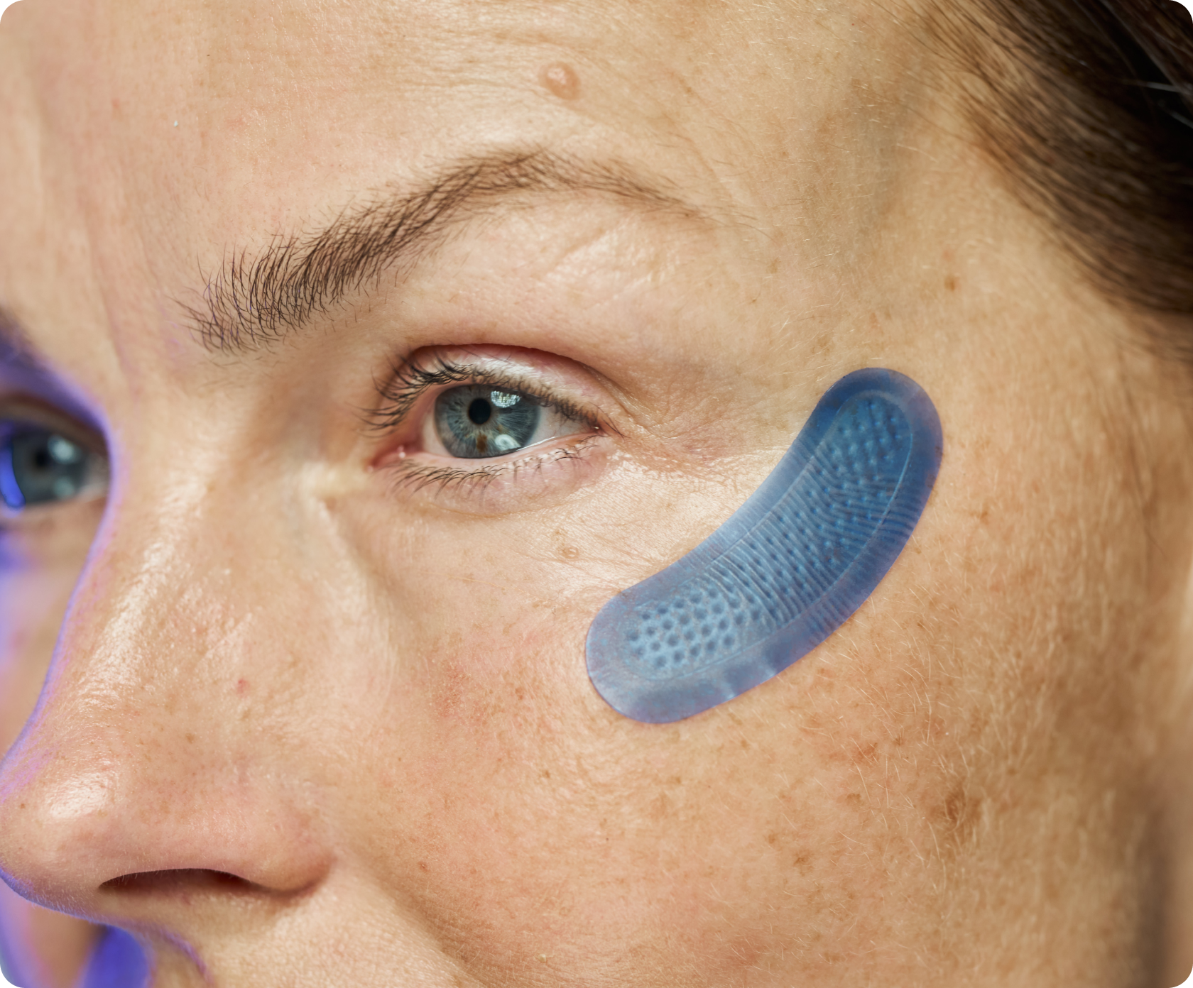 Micro-Infusion Targeted Patches